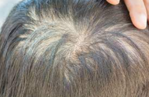 Best Certified Trichologist Baltimore Hair Loss Treatment