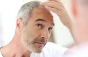 Best FUE Hair Transplant Denver - Hair Loss Center Colorado, USA