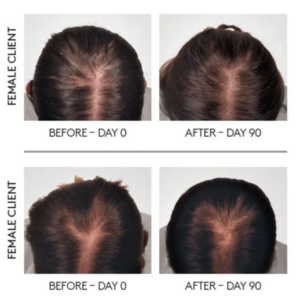 Discover the Best Hair Regrowth Treatment for You