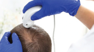 Best Hair Transplant Denver Co