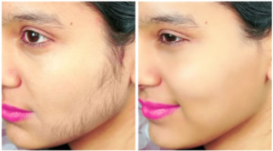 How to Stop Facial Hair Growth in Females Naturally