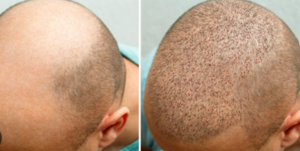 Best Hair Transplant Colorado Springs