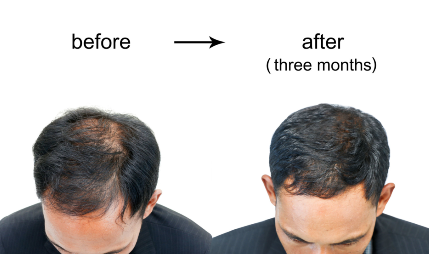 Best Hair Replacement West Palm Beach - Trichologist Finder