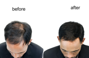 Cost of Hair Transplant 1 The Cost of Hair Transplant